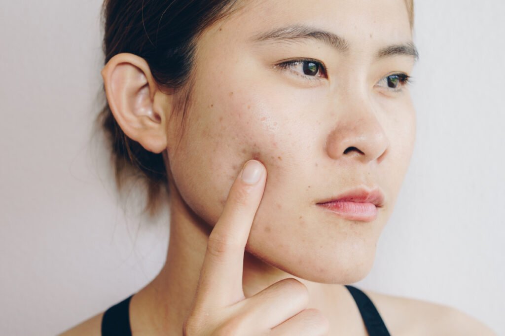 What can I do about my acne scars? The types of acne scars & how to treat them